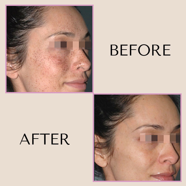 Before and after on the face from Morpheus8