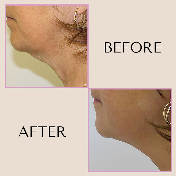 Discover the Power of Non-Surgical ‘Evoke Facial Contouring’ at Bedford Skincare Clinic