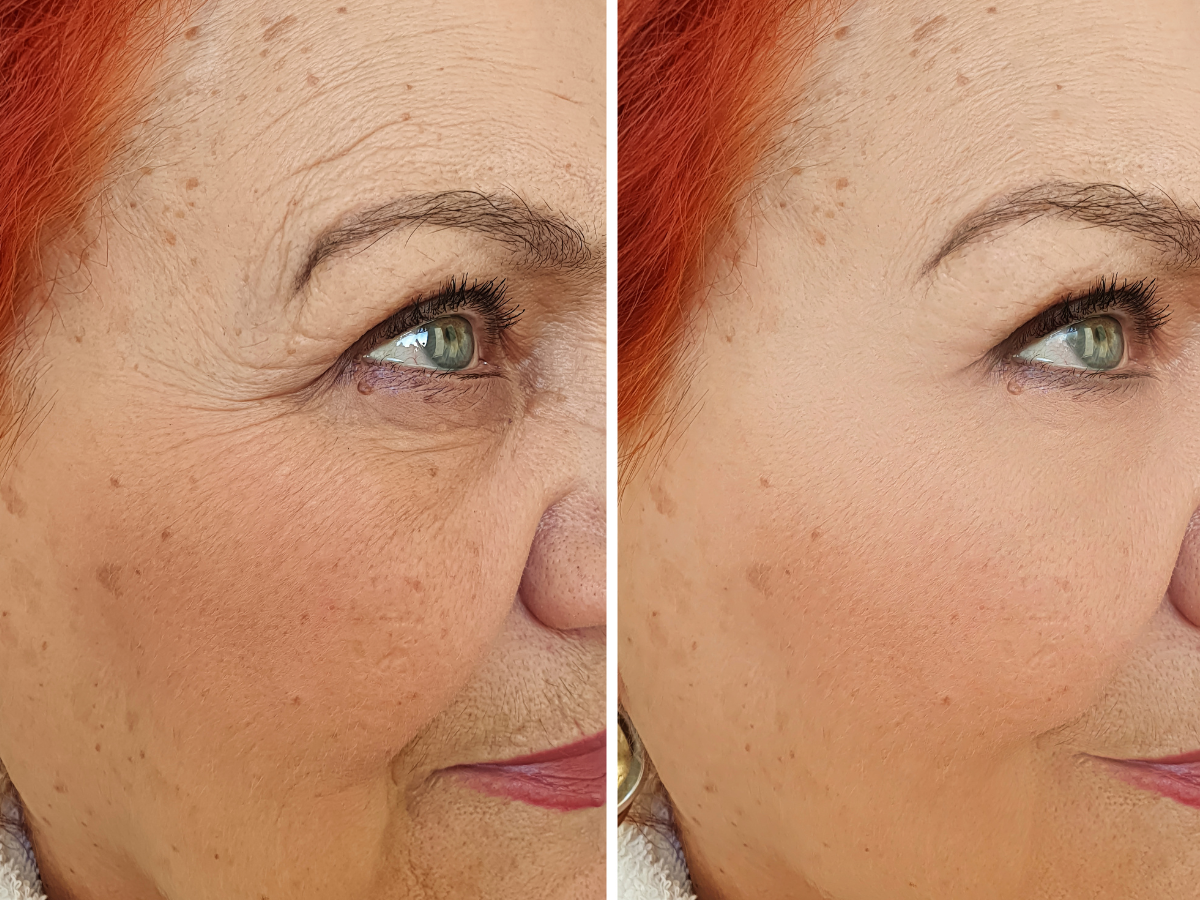 Lumecca IPL: Advanced Skin Rejuvenation for Clear, Even Skin